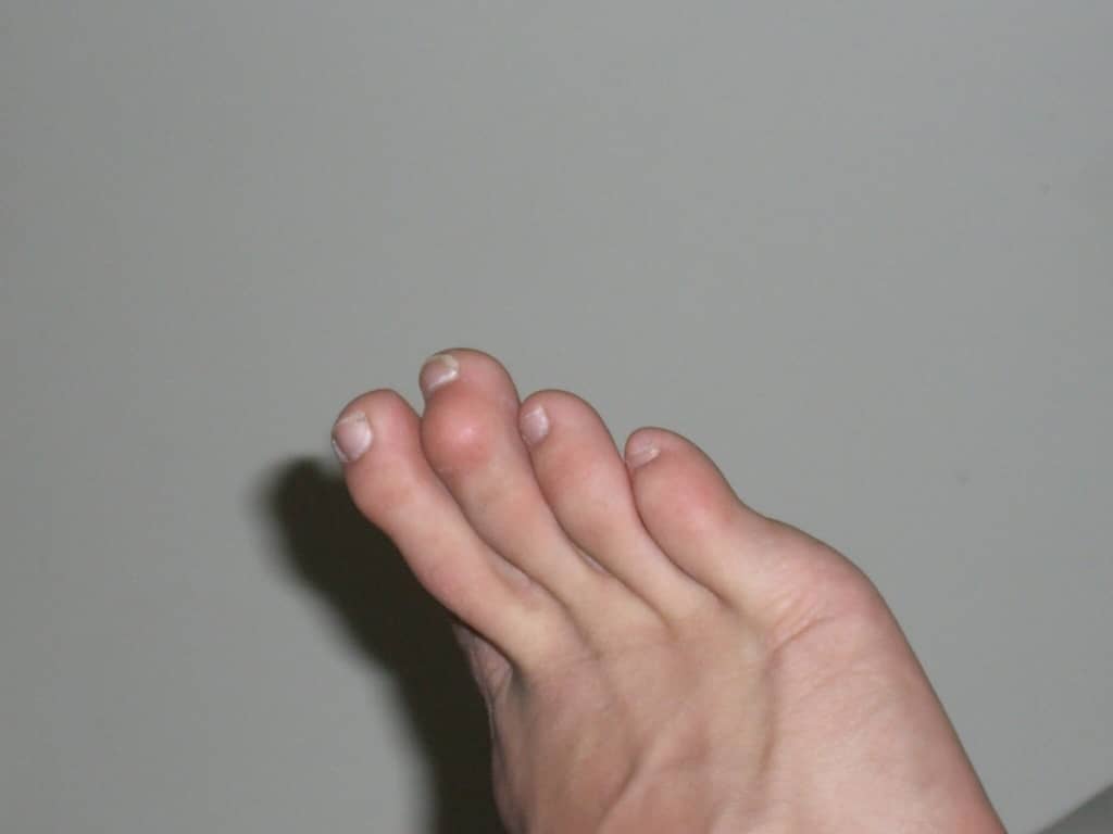 human foot with mallet toe. how to stop toes from curling